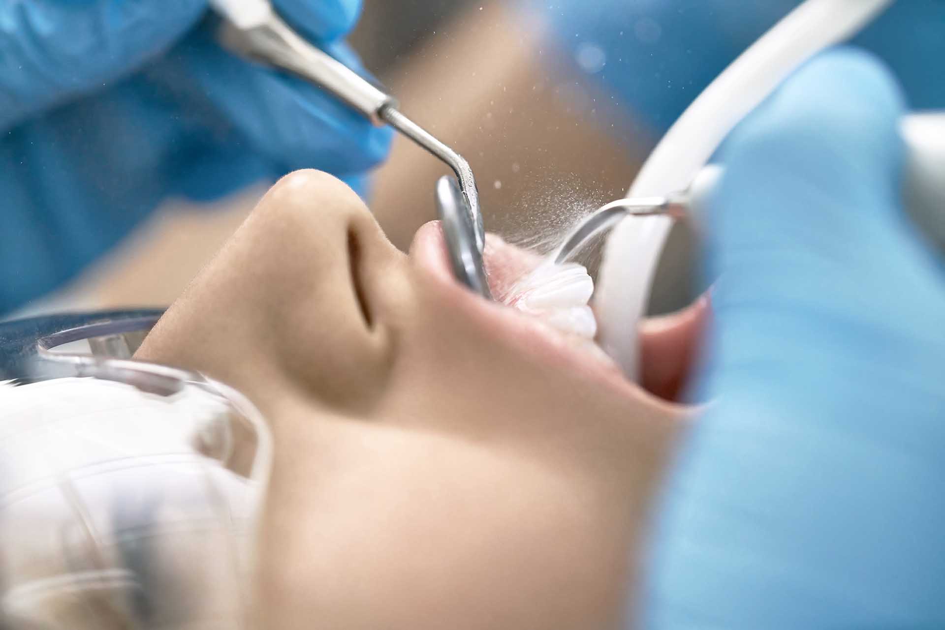 dentist-cleaning-patients-teeth